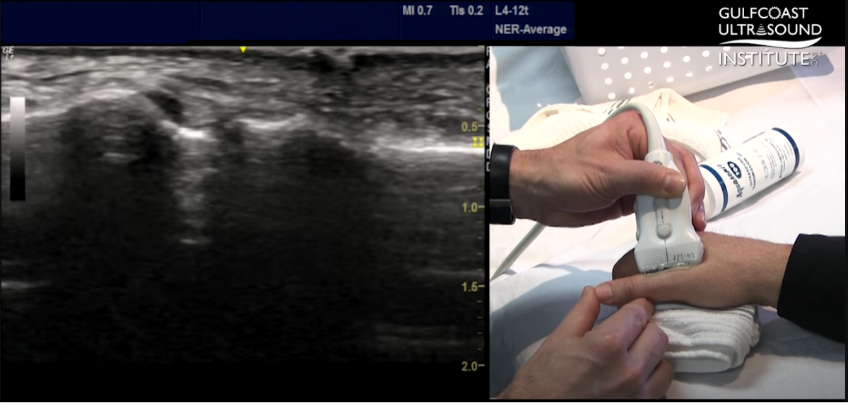 Ultrasound Evaluation of Gamekeeper's Thumb aka Skier's Thumb